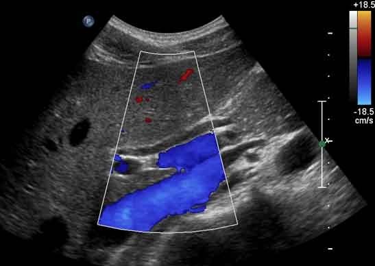 Cholelithiasis And Choledocholithiasis 123sonography